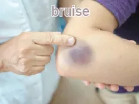 Định nghĩa của từ <b>bruise</b>
