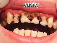 Định nghĩa của từ <b>cavity</b>