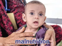 Định nghĩa của từ <b>malnutrition</b>